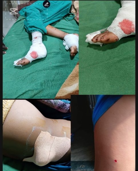 बिष्पोटबाट घाइते बालकहरुको सफल सल्यक्रिया : अबस्था सामान्य  